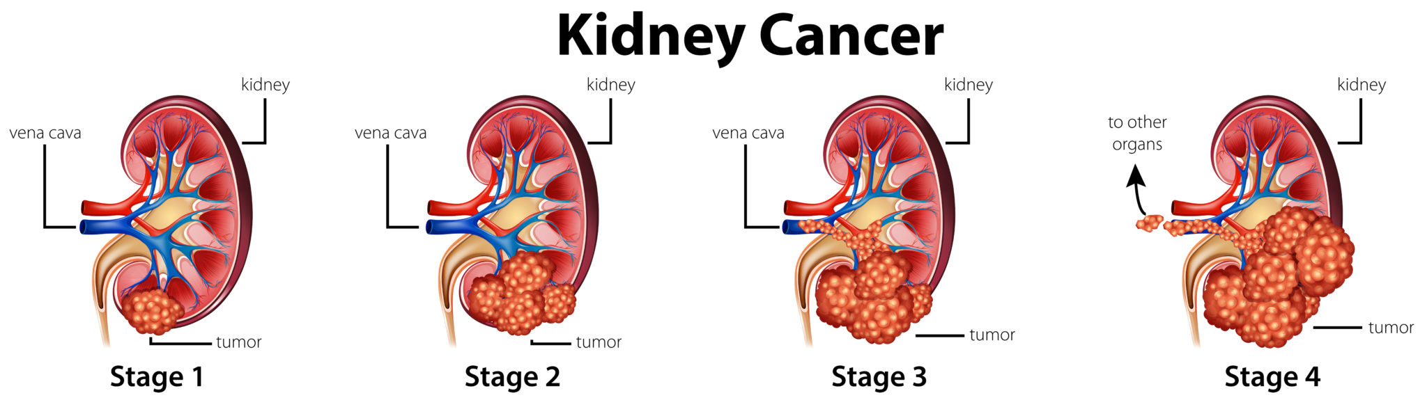 latest research on kidney cancer