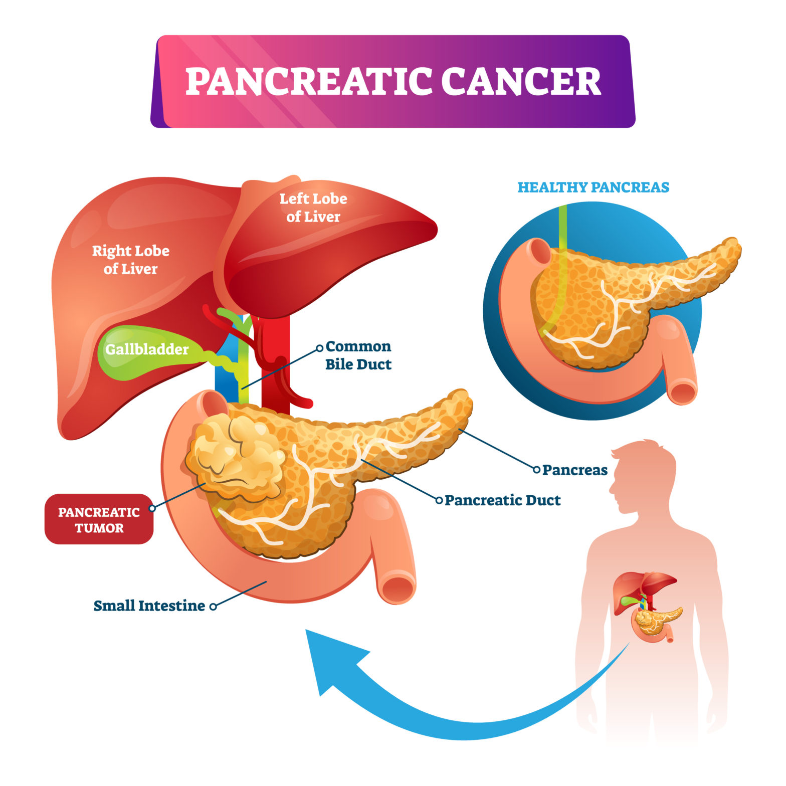 Pancreatic Cancer The Cancer Foundation 7264