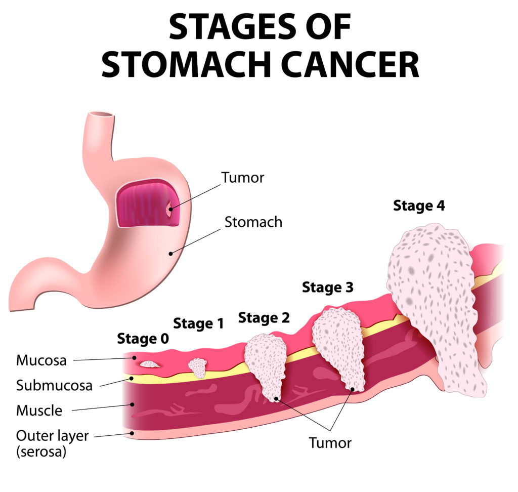 Stomach Cancer The Cancer Foundation 1749